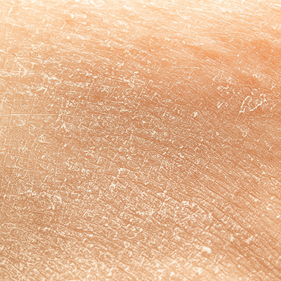 dry skin texture