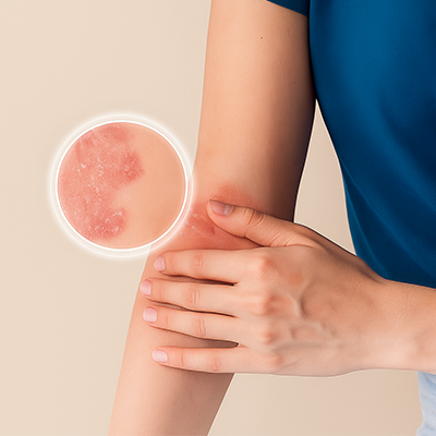 Close-up of a person's arm with visible eczema skin condition and a magnified inset on a beige background