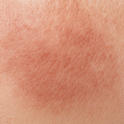 sensitive skin texture