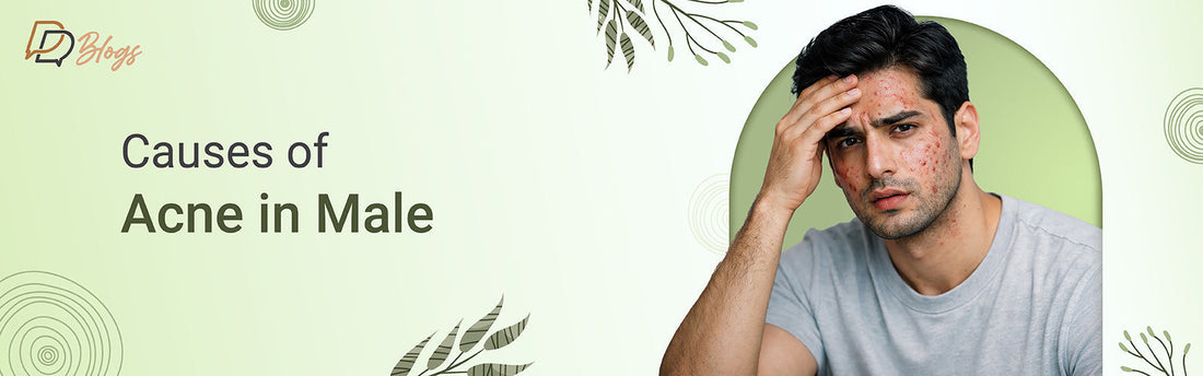 Causes of Acne in Male