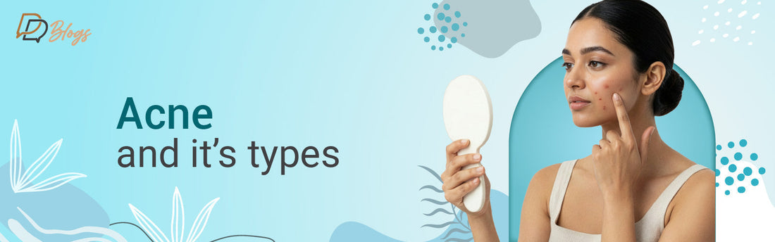 Acne and it’s type